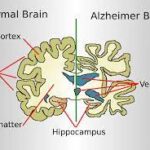 Everything You Need to Know About Alzheimer Disease